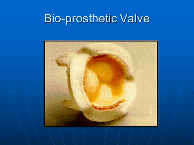 Bio-prosthetic Valve